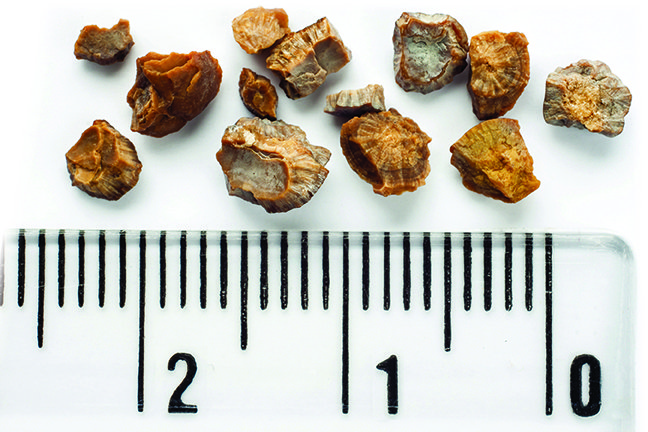 Learn More about Kidney Stones and How to Avoid Them